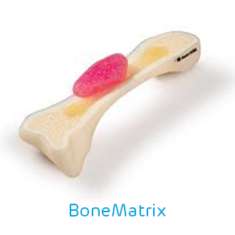 BoneMatrix 3D nyomtató alapanyag