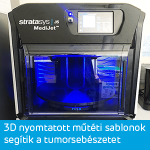 3D nyomtatott műtéti sablonok segítik a tumorsebészetet